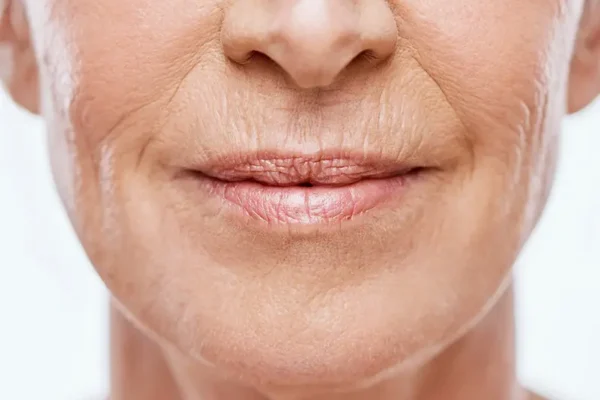 How To Get Rid Of Lips Wrinkles Around Mouth Forever