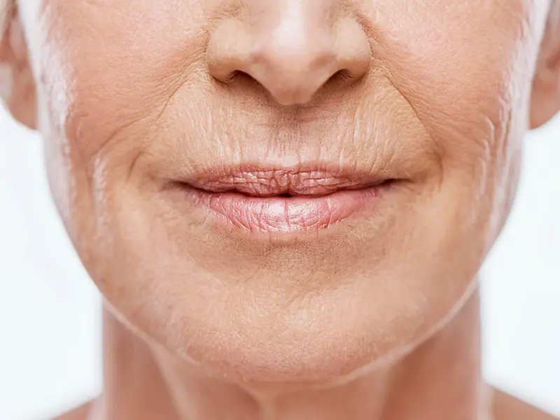 How To Get Rid Of Lips Wrinkles Around Mouth Forever